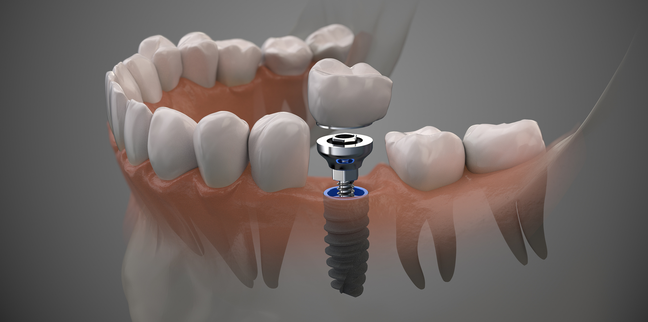 Illustration of a dental implant in Bartlett with a dental crown replacing a missing lower tooth
