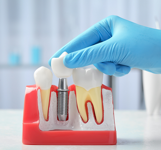 Dentist placing a crown over a model of a dental implant