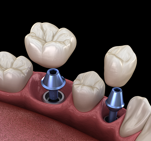 Illustration of two dental implants with a crown being placed atop each of them