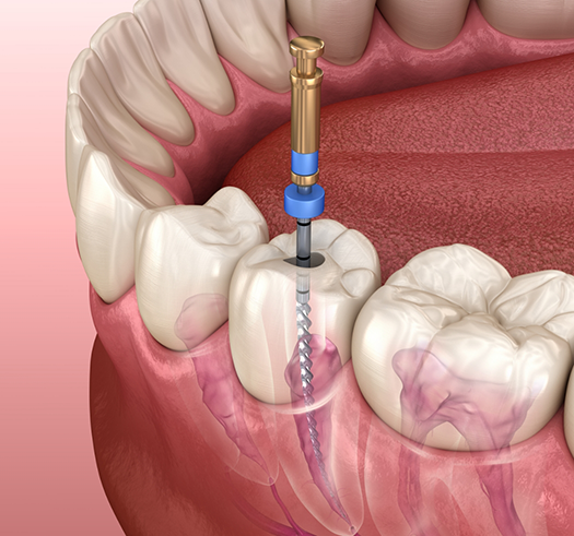 Illustration of a thin dental instrument treating the inside of a tooth
