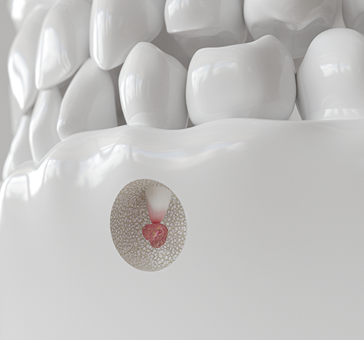 Illustration of a tooth with a bump at the root indicating an infection