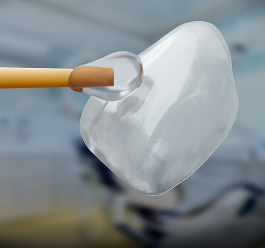 Close up of adhesive material being applied to a dental veneer