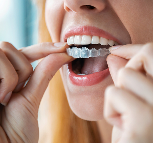 Blonde woman placing an Invisalign aligner over her teeth
