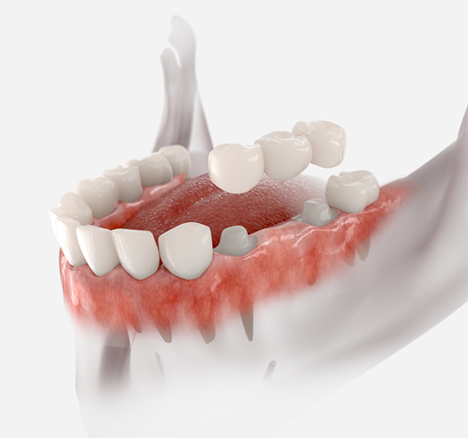 Model of a dental bridge being placed onto two natural teeth to fill the gap between them