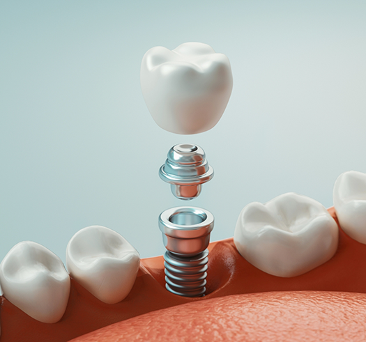 Illustration of a dental implant with a dental crown being placed in the lower jaw