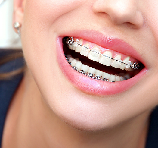 Close up of a person grinning with clear and ceramic braces