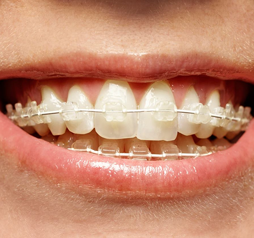 Close up of a smile with braces with clear brackets