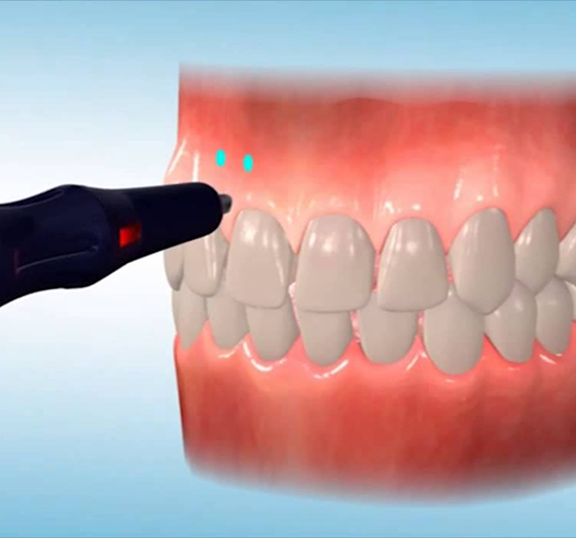 Pen like device pointing to an illustration of the teeth and gums