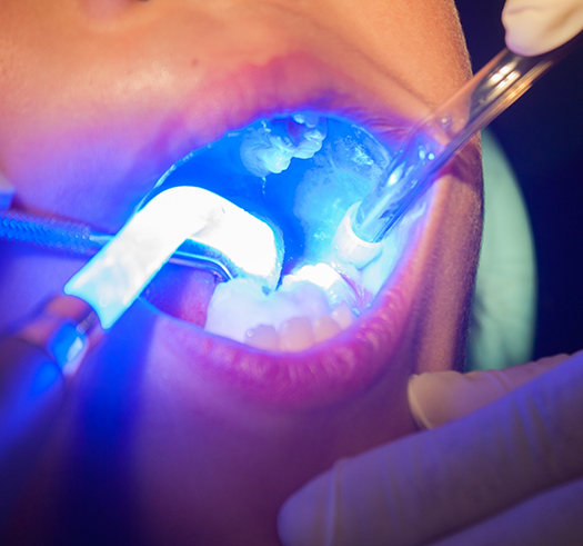 Close up of a child dental patient having dental sealants applied to their teeth