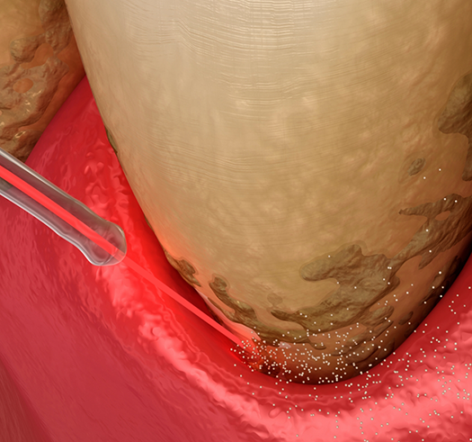 Illustration of a dental laser treating gum disease