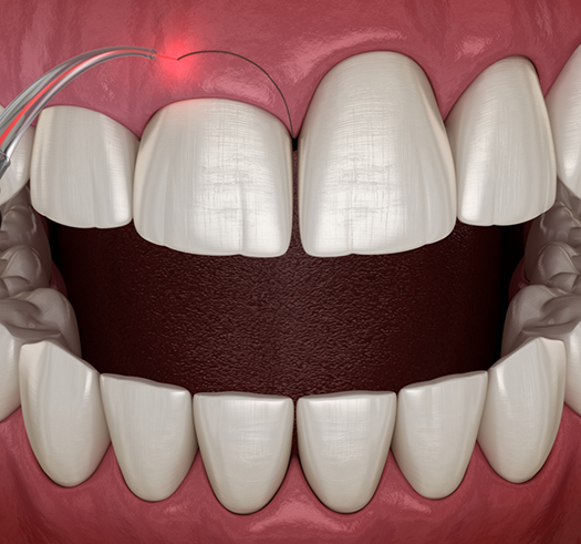 Illustration of a dental laser treating an uneven gumline
