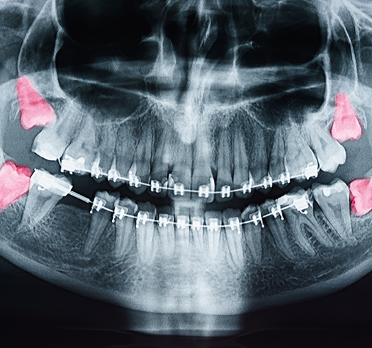 X ray of teeth with the wisdom teeth highlighted red